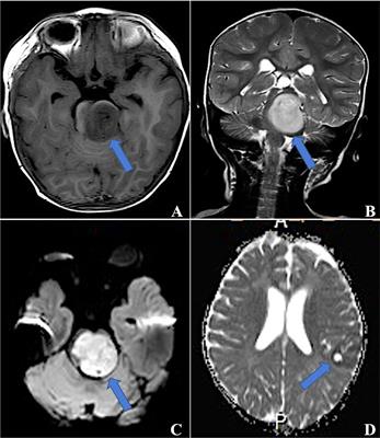 Embryonal tumors with multilayered rosettes, C19MC-altered or not elsewhere classified: Clinicopathological characteristics, prognostic factors, and outcomes of 17 children from 2018 to 2022